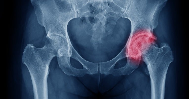 Quels sont les mouvements à éviter après la pose d'une prothèse de hanche ?