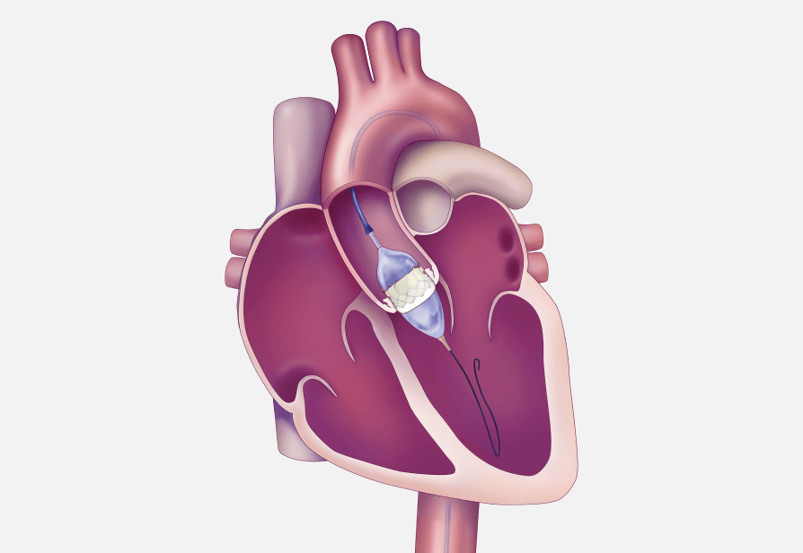 Remplacement valve cardiaque Tunisie