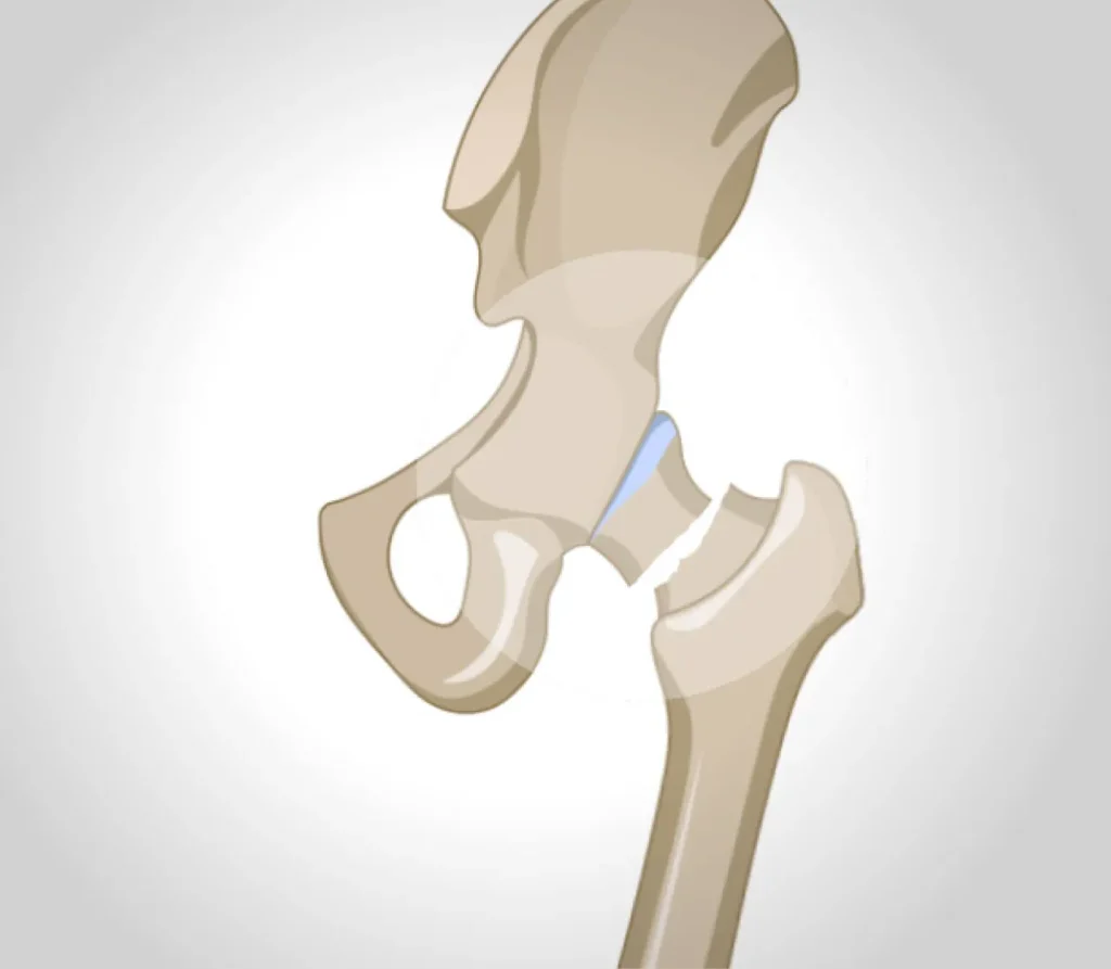 Quelle opération pour une fracture de la hanche ?